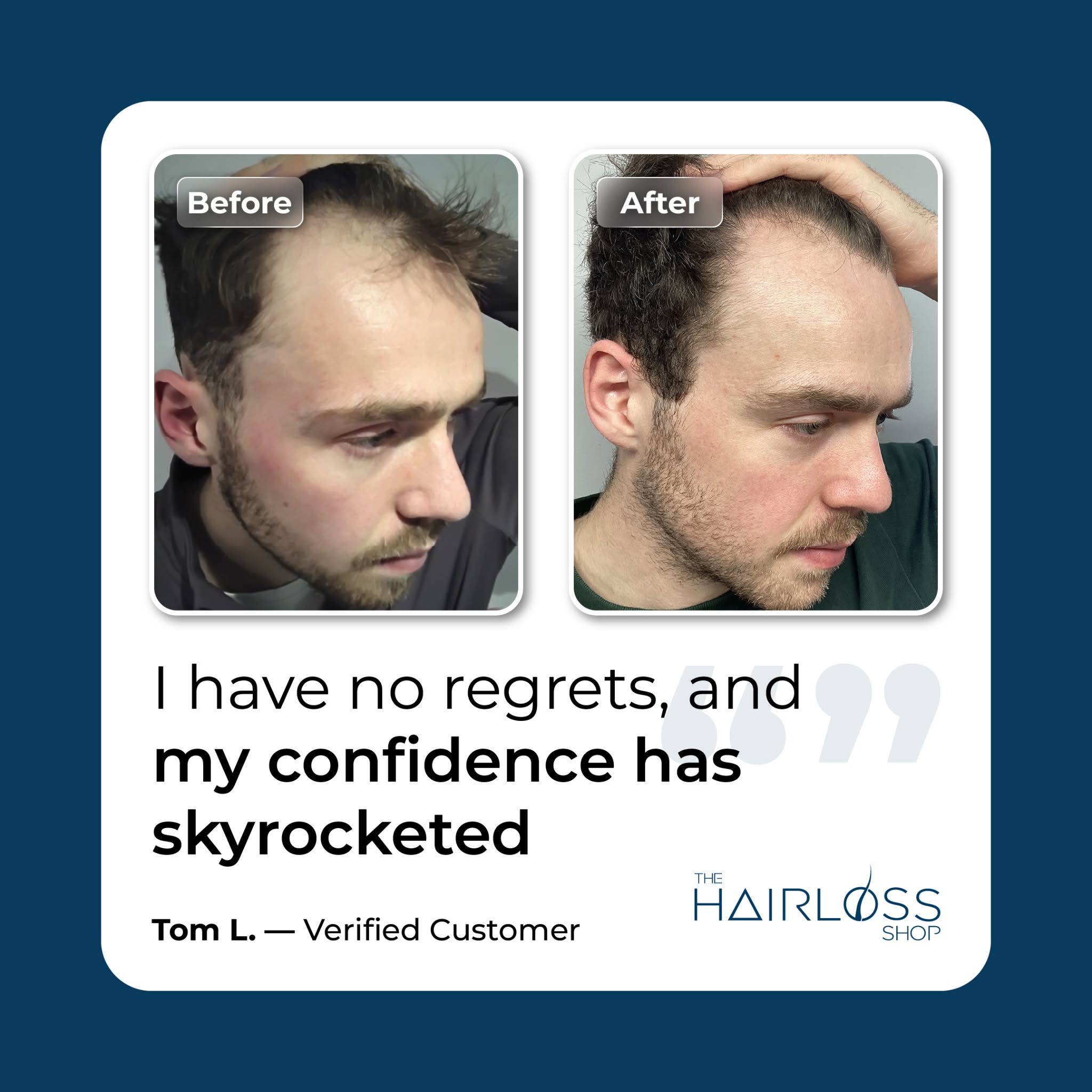 Collection of Men's Hair Loss Treatment - Formula A+ in a gallery layout