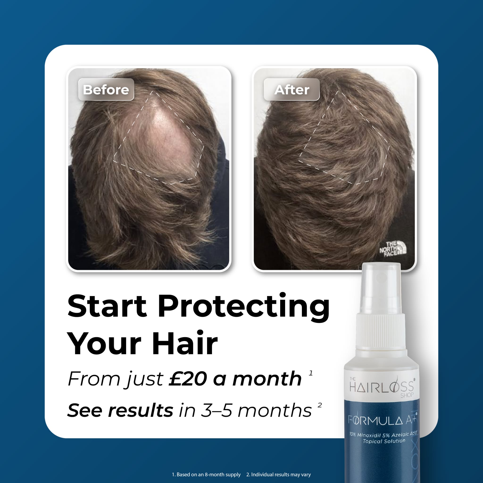 Collection of Men's Hair Loss Treatment - Formula A+ in a gallery layout
