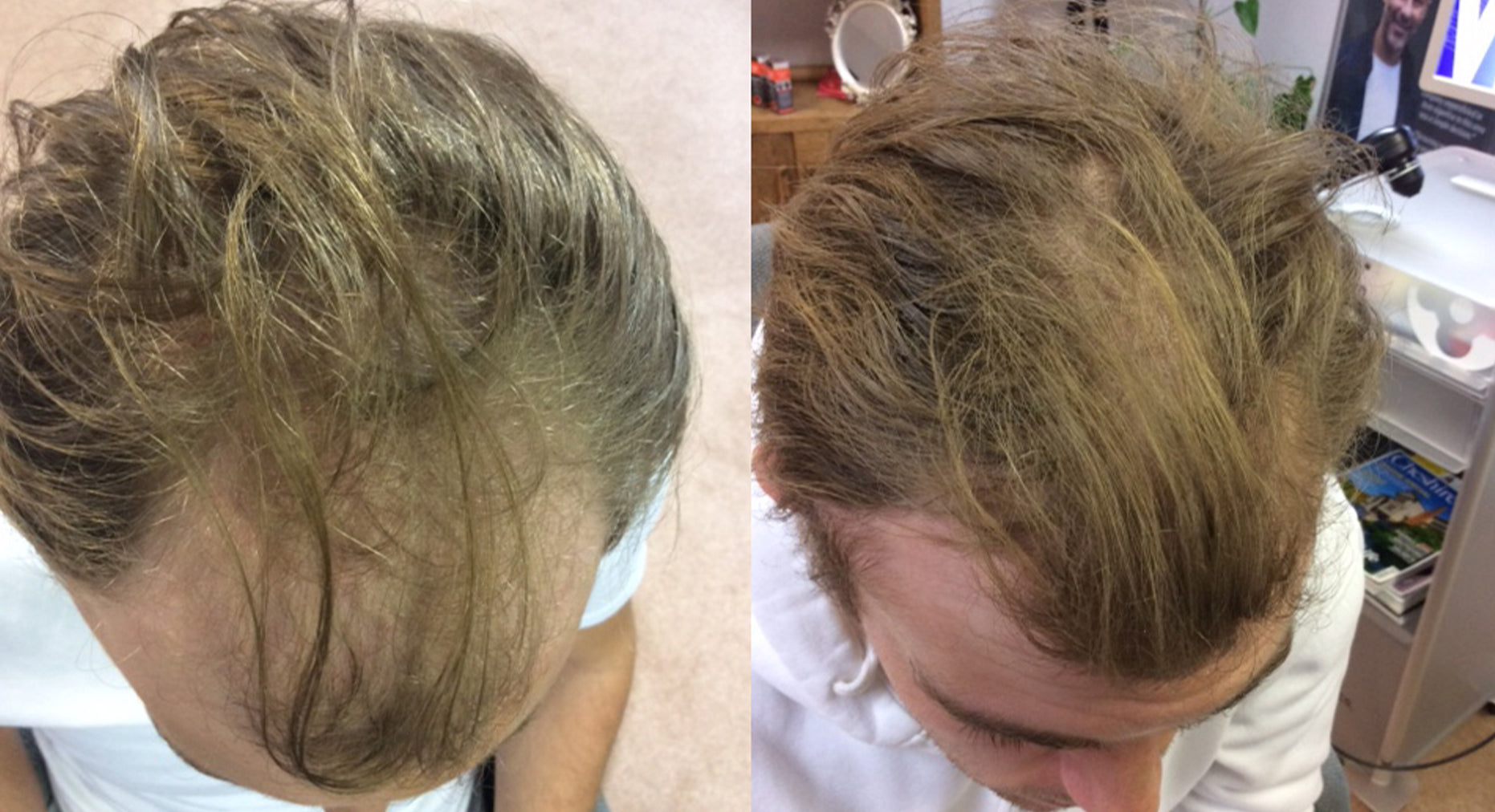 Collection of Men's Supercharged Hair Loss Treatment in a gallery layout