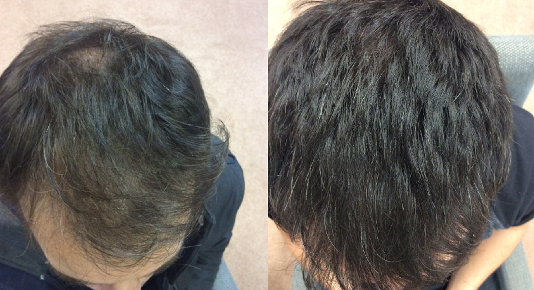 Collection of Men's Supercharged Hair Loss Treatment - Formula F+ Max in a gallery layout