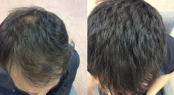 Collection of Men's Supercharged Hair Loss Treatment in a gallery layout