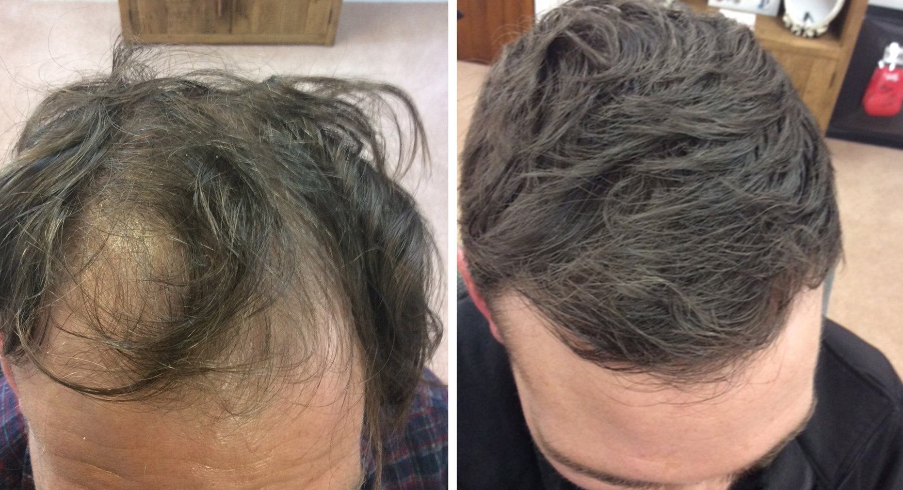 Collection of Men's Hair Loss Treatment in a gallery layout