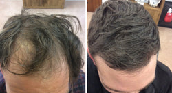 Collection of Men's Hair Loss Treatment in a gallery layout