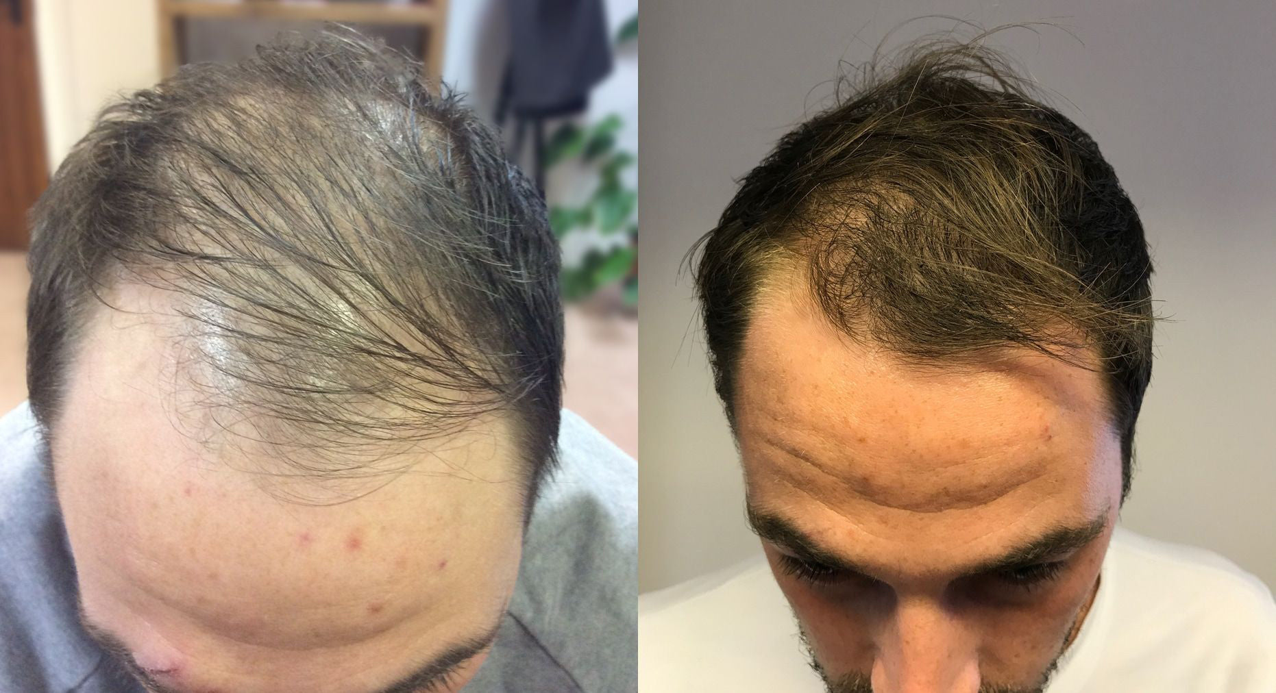 Collection of Men's Hair Loss Treatment in a gallery layout