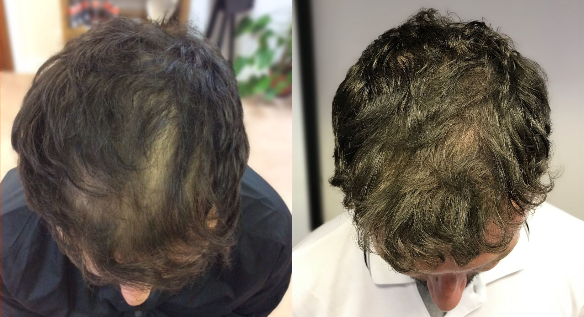 Collection of Men's Supercharged Hair Loss Treatment in a gallery layout