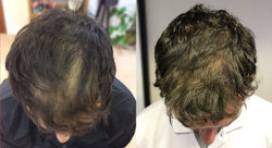 Collection of Men's Supercharged Hair Loss Treatment in a gallery layout