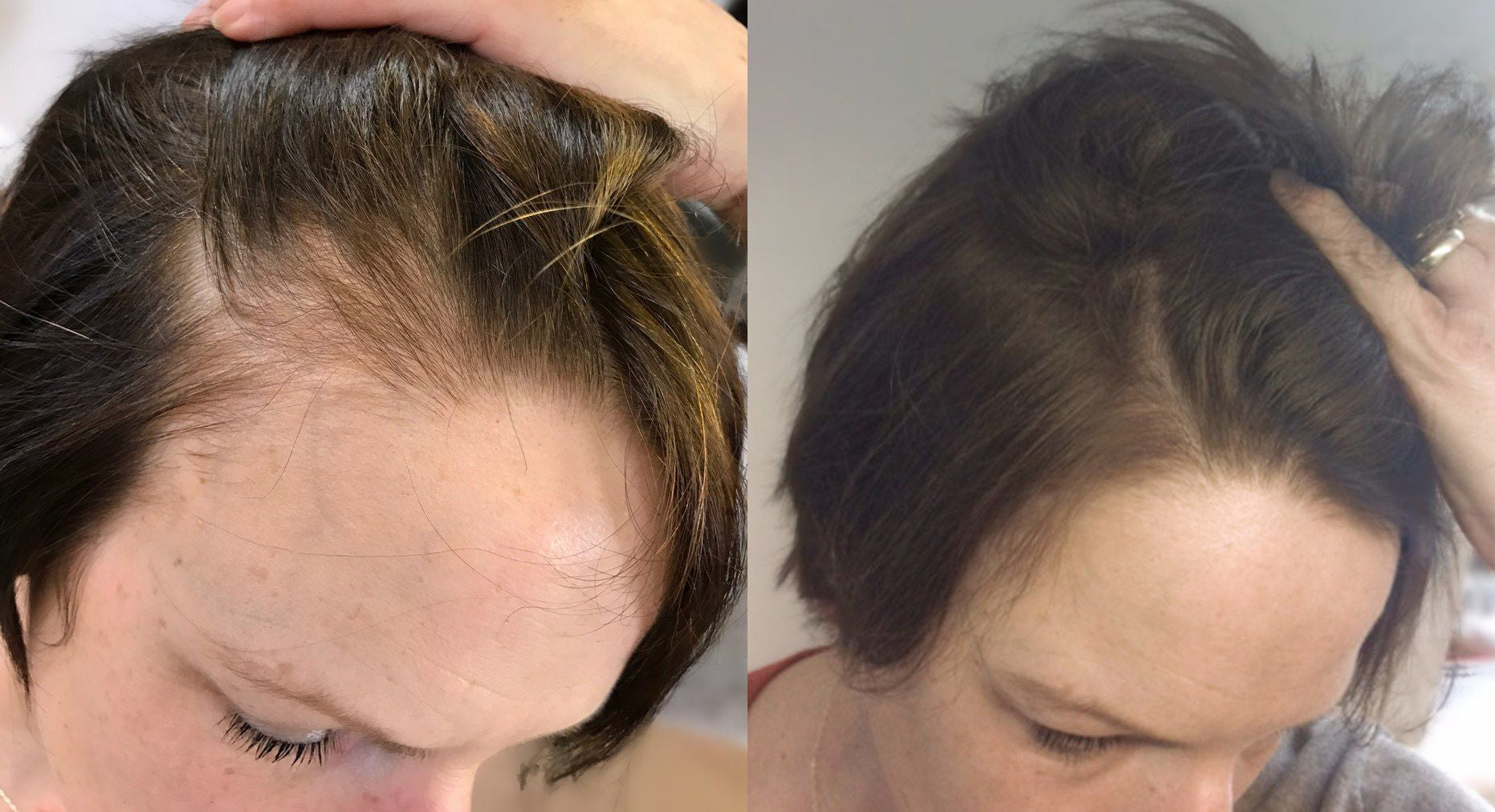 Collection of 'FORWOMEN' - Women's Hair Loss Treatment in a gallery layout