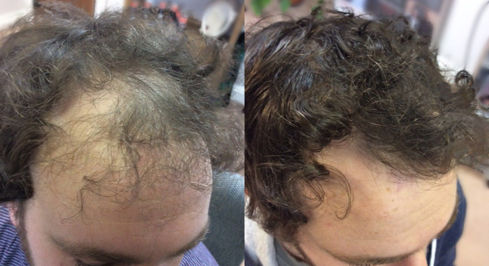 Collection of Men's Hair Loss Treatment - Formula A+ in a gallery layout