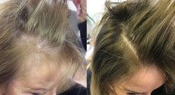 Collection of 'FORWOMEN' - Women's Hair Loss Treatment in a gallery layout