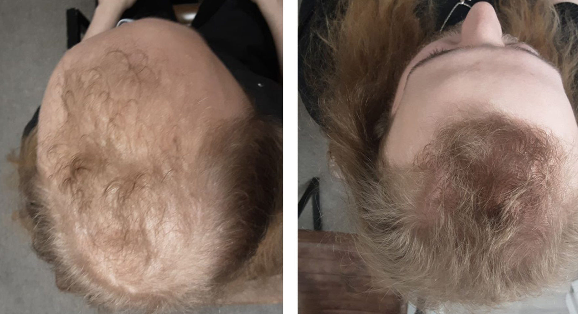 Collection of Men's Hair Loss Treatment - Formula A+ in a gallery layout