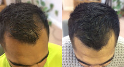 Collection of Men's Hair Loss Treatment in a gallery layout
