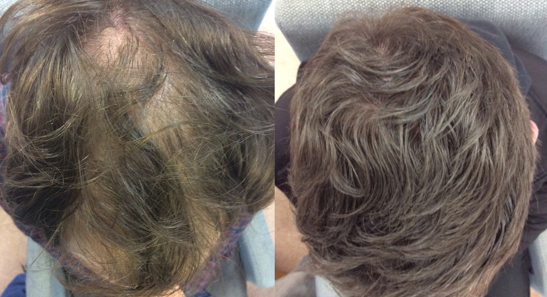 Collection of Men's Hair Loss Treatment in a gallery layout