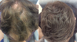 Collection of Men's Hair Loss Treatment in a gallery layout