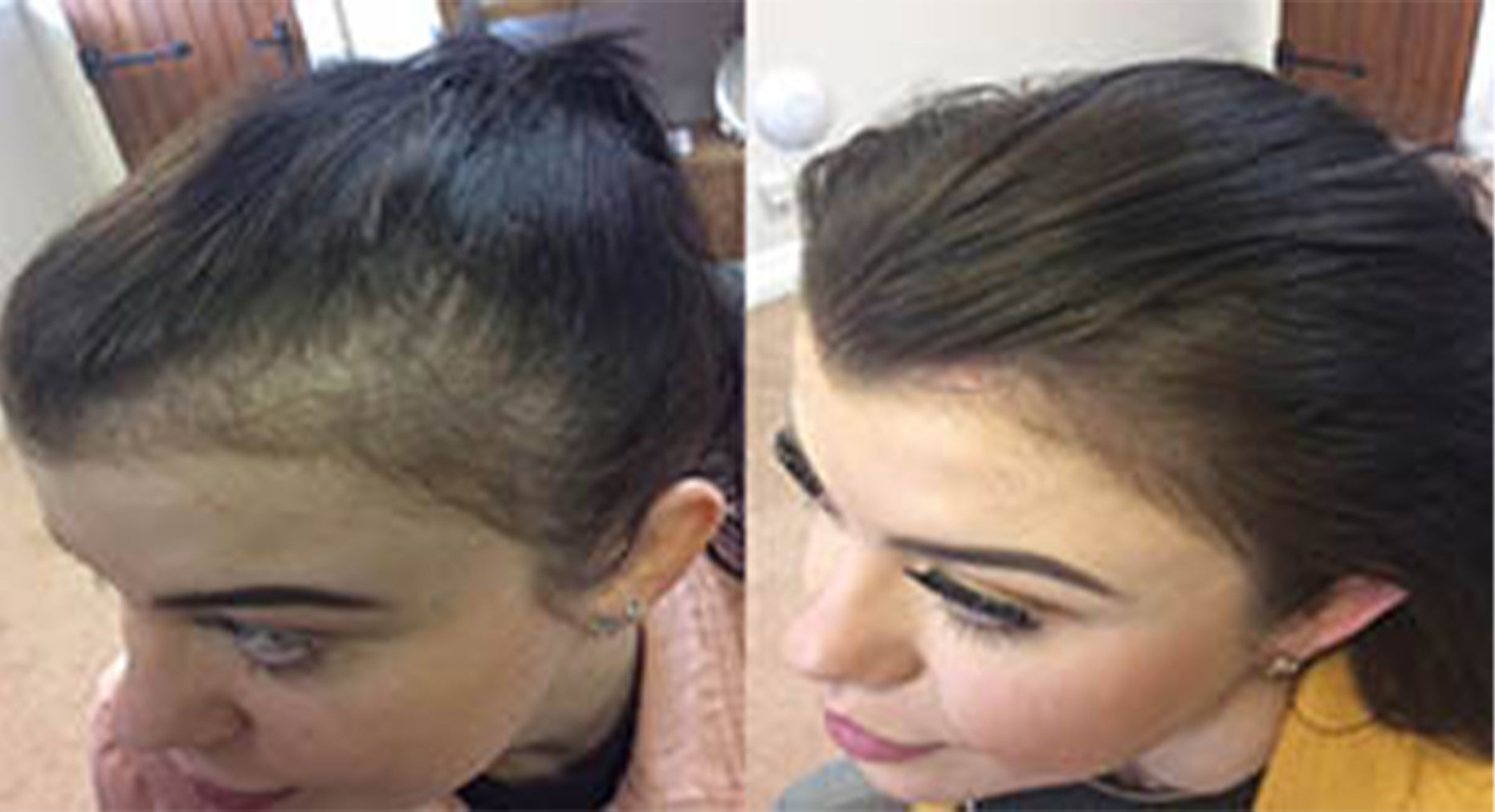 Collection of 'FORWOMEN' - Women's Hair Loss Treatment in a gallery layout
