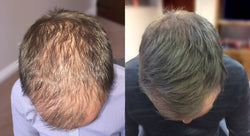 Collection of Men's Hair Loss Treatment in a gallery layout