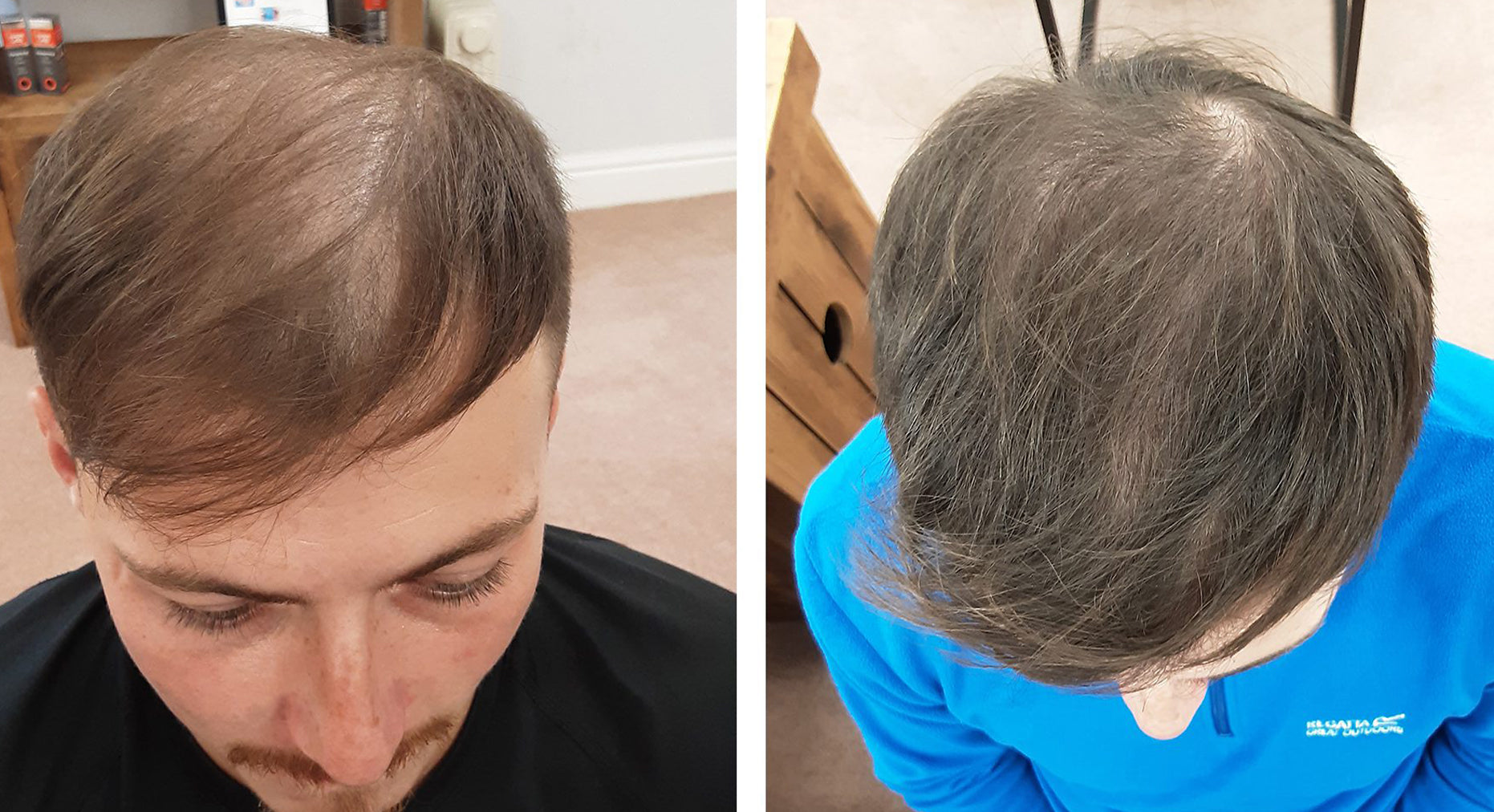 Collection of Men's Hair Loss Treatment in a gallery layout
