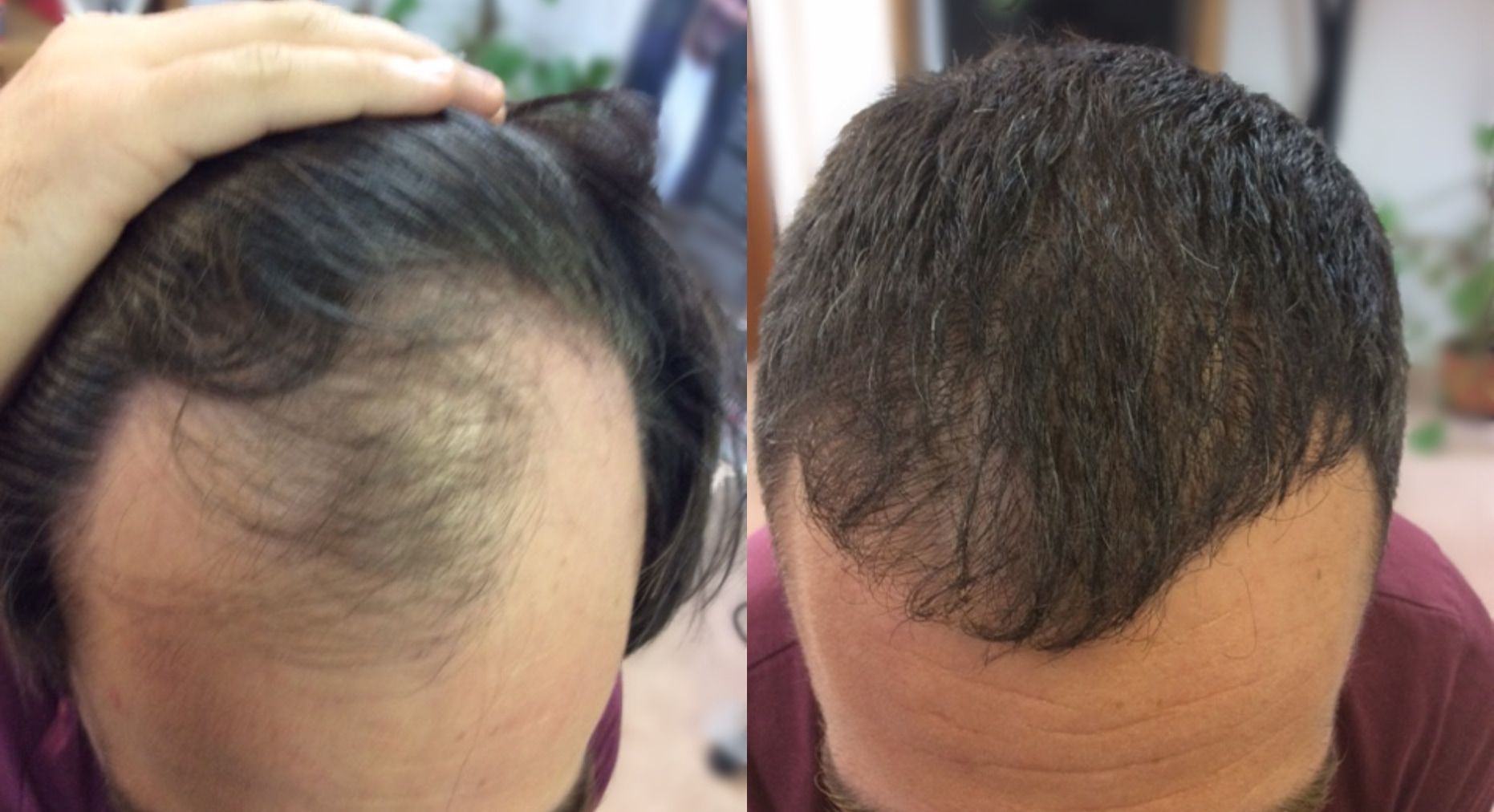 Woman's before and after hair regrowth results