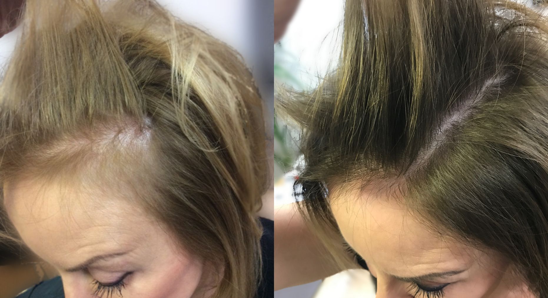 Woman's before and after hair regrowth results